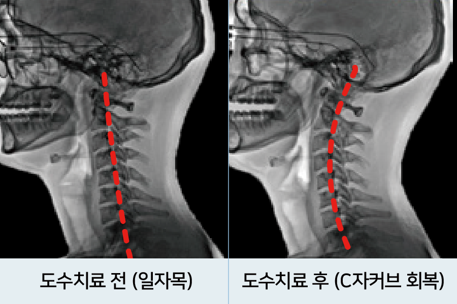 거북목 / 일자목